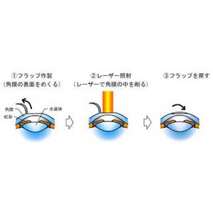 消費者庁、「レーシック手術を安易に受けることは避けましょう」注意呼びかけ