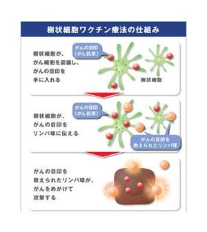 テラ、樹状細胞ワクチン「バクセル」の局所再発胃がんに対する有効性を発表