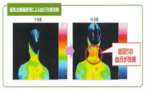 花粉によるアレルギー症状が肩こり・腰痛につながる? 原因と解消法を知る