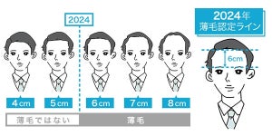 おでこの広さ何cmから? 意識調査で「薄毛の境界線」が明らかに