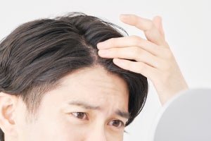 男性の約8割が「頭髪・頭皮の悩み」を抱えている! 若年層の意識が変化?