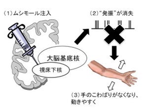 NIPS、パーキンソン病の運動障害の原因となる脳の電気信号異常を発見