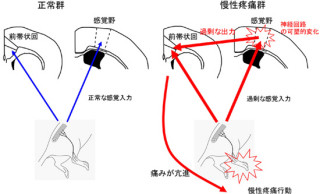 NIPS、慢性疼痛の発生による脳内のシナプスの短期間での変化を確認