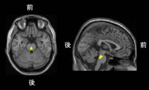 漱石の「坊ちゃん」はセロトニントランスポーター密度が低い人 - 放医研