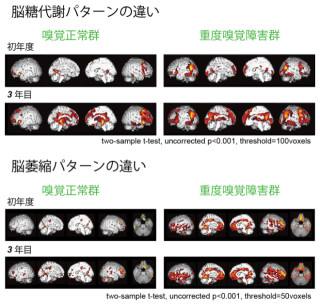 東北大、嗅覚検査でパーキンソン病における認知症発症を予測可能と発表