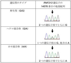 横浜市立大学など、重症型もやもや病の遺伝マーカーを発見