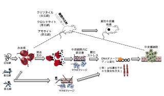 名大、アスベストの中皮腫発がん過程では「鉄過剰」が主要病態と解明