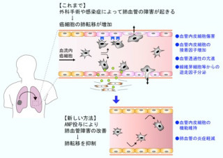 国循研、心臓ホルモン「ANP」が多様ながんの転移を予防・抑制すると究明