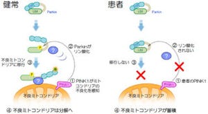 順天堂大、若年性遺伝性パーキンソン病の発症の仕組みの一部を解明