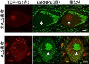 理研など、ALSとSMAの療法に共通する神経細胞変性のメカニズムの一端を解明