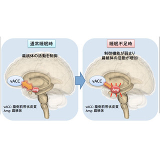 睡眠不足が不安・抑うつを生じやすくする - NCNPが脳内のメカニズムを解明