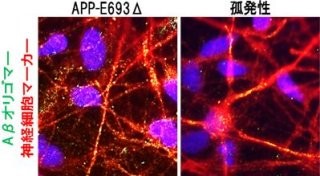 京大など、アルツハイマー病には複数の病態があることを確認