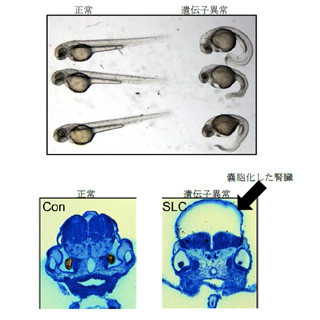 東北大、先天性嚢胞性腎疾患「ネフロン癆」の原因となる遺伝子変異を発見