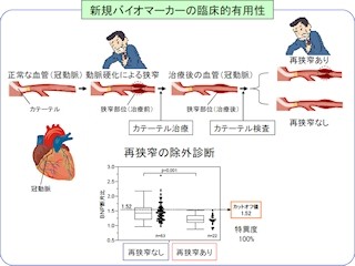 東大病院など、心臓カテーテル検査の実施を簡単に判定できる検査法を開発