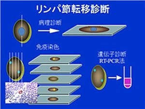 第2病期大腸がん患者の術後の再発率はリンパ節の微小転移の量による - 阪大