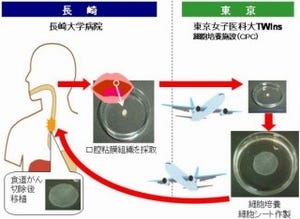 長崎大など、細胞シートによるがん患者に対する再生医療を実施