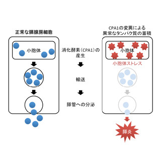 東北大など、若年で発症する膵炎の新規原因遺伝子を発見