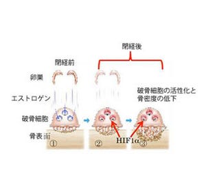 閉経後骨粗鬆症の原因タンパク質を特定