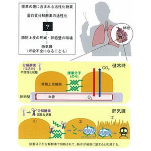 近大など、喫煙が招く代表的な病気「肺気腫」の発症メカニズムを発見