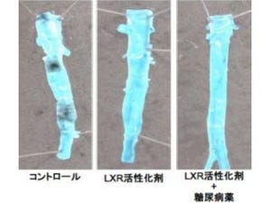 「肝臓X受容体」の活性化が動脈硬化の進展を抑制する - 名大など