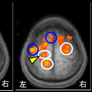 京大、うつ/パーキンソン病などの最新治療法「電磁気刺激法」の機構を解明