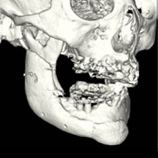 理研など、0.1mm単位で形状再現できる3Dプリンタ利用人工骨の薬事承認を申請