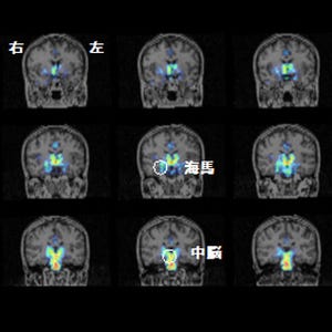 慢性疲労症候群患者では脳内炎症が広い領域で生じている - 理研などが確認