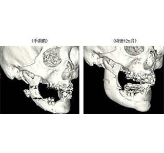 3Dプリンター成形の人工骨を承認申請