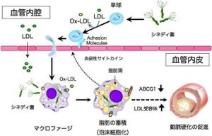 東北大など、動脈硬化症の進展を促進する病原体を発見