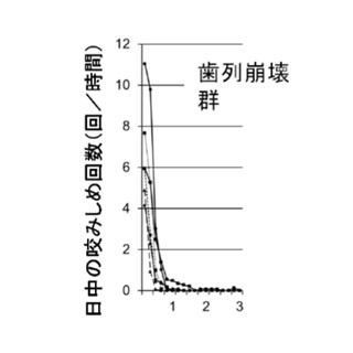 昼間のかみしめが歯の崩壊につながる - 岡山大が発表