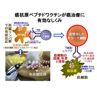 頭頸部がんに対しペプチドワクチン投与により生存期間が延長 - 熊本大など