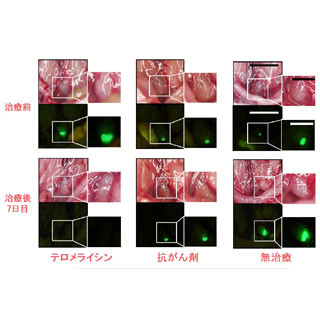 岡山大、体の負担少なく消化器がんのリンパ節転移を完全消去する新治療法