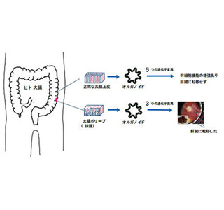 体外で大腸がん再現、腺腫のリスク実証