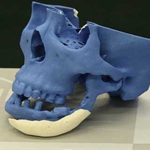 医療ベンチャー開発の3Dプリント人工骨、欧州で販売へ