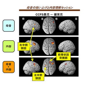 理研、小児慢性疲労症候群の脳活動を測定 - 前頭葉の過活動を確認