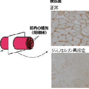 東北大、筋萎縮と筋力低下が進行する遺伝性筋疾患の原因遺伝子群を解明