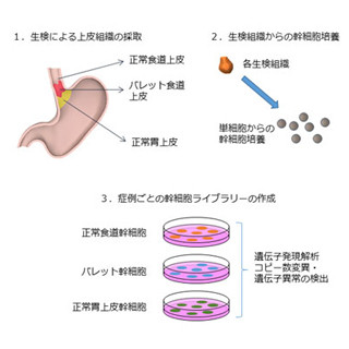 国がん、食道がんの前がん病変で幹細胞を発見