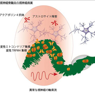 新潟大、多発性硬化症/視神経脊髄炎における神経変成の新たな仕組みを発見