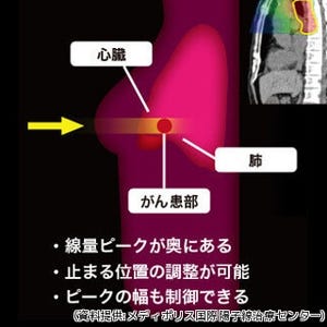 身体にやさしいがん治療 - 「陽子線治療」について名医に聞く