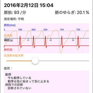 東大とドコモ、不整脈と生活習慣病の関連をスマホアプリで解析する臨床研究