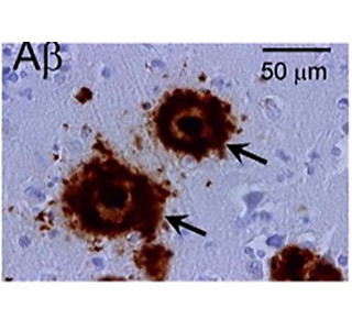 アルツハイマー病原因物質の構造変化を確認 金沢大