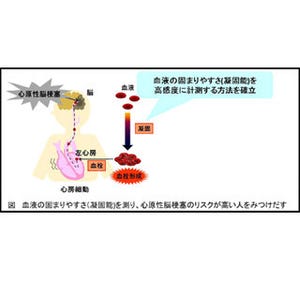 血液の固まりやすさ正確に計測 脳梗塞リスク判断に威力