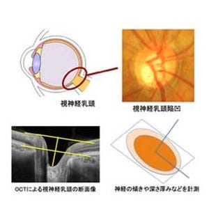 東北大とトプコン、緑内障分類を自動で行うソフトウェアを開発