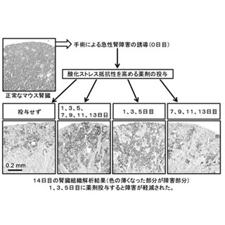 「酸化ストレス」が腎臓病を悪化させ、慢性腎臓病が発症する - 東北大