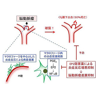 京大、脳動脈瘤の形成や進行に重要な炎症反応の仕組みを解明