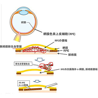 山中伸弥教授ら、加齢黄斑変性に対するiPS細胞を用いた治療の安全性を立証