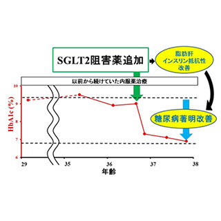 糖尿病の内服薬であるSGLT2阻害薬で脂肪萎縮性糖尿病が改善 - 東北大