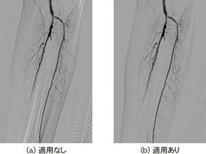 島津製作所、低侵襲・効率的な血管内治療を支援する画像処理技術を開発