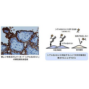 神奈川がんセンター、新しい中皮腫がんマーカー「シアル化HEG1」を発見