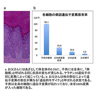 表皮融解性母斑患者の子に、全身の表皮融解性魚鱗癬が発症するリスクを予測